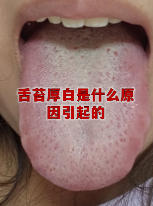 舌苔白厚腻是什么原因造成的 舌苔白厚腻是什么原因造成的